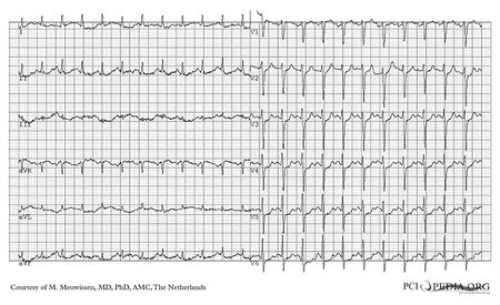 Positive Exercise test, no coronary laesions - PCIpedia